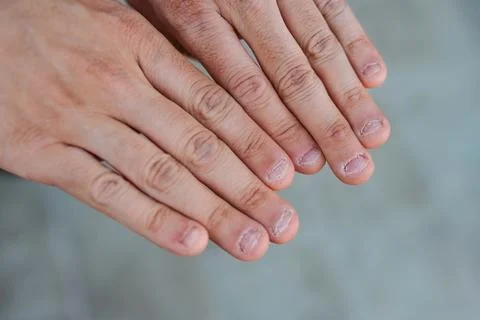 Close up detail of two hands with bitten and ugly nails Stock-Fotos