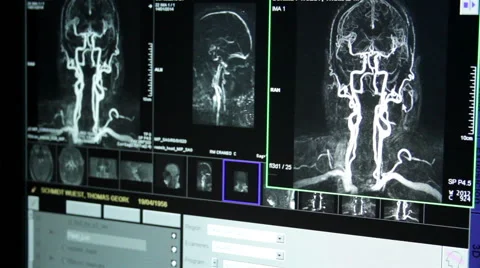 CLOSE UP. Doctor explain with his hands a brain scan that is shown in a monitor. Stock Footage 51334035