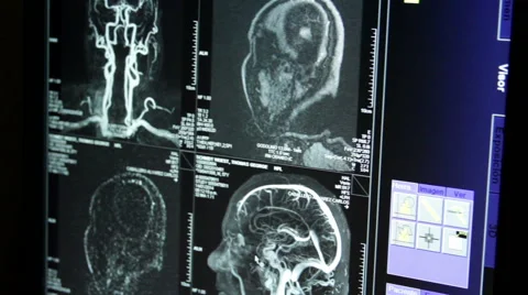 CLOSE UP. Doctor explain with his hands a brain scan that is shown in a monitor. Stock Footage 51335388