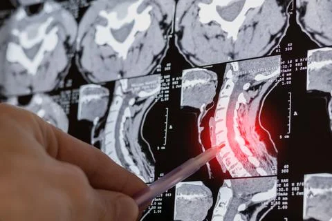 Close up, doctor learning MRI or X-ray of curvature vertebrae spine. Stock Photos