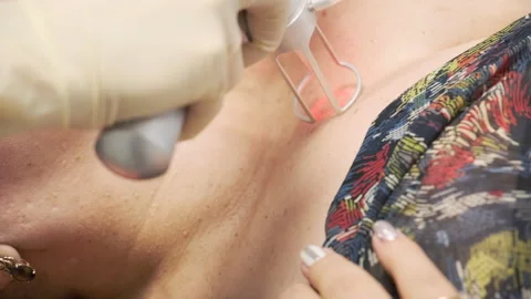 Close-up. The doctor performs a procedure for lifting with a laser Stock Footage 144986041