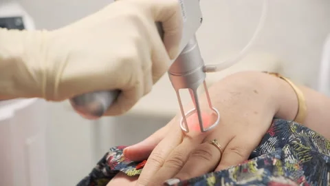 Close-up. The doctor performs a procedure for lifting with a laser Stock Footage 144988437