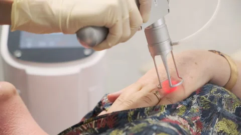 Close-up. The doctor performs a procedure for lifting with a laser Stock Footage 144989410