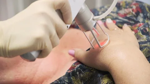 Close-up. The doctor performs a procedure for lifting with a laser Stock Footage 144990354