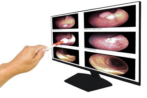 Close up Doctor point out the computer screen, report of gastrointestinal e.. Stock Photos