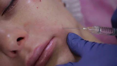 Close-up of a doctor's hand doing a cosmetic procedure for the skin of the face Stock Footage 148252719