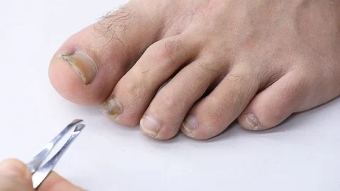 Close-up of doctor's hand examining a deformed nail that comes off a mans foo Stock Footage 118569098