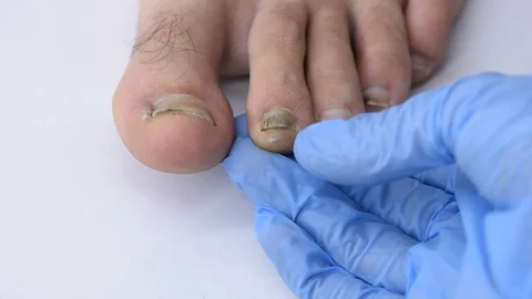 Close-up of doctor's hand examining a deformed nail that comes off a mans foo Stock Footage 118569103
