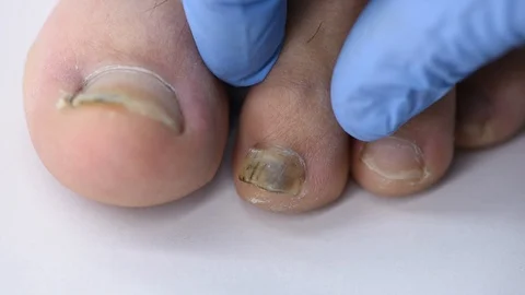 Close-up of doctor's hand examining a deformed nail that comes off a mans foo Video stock 118569104