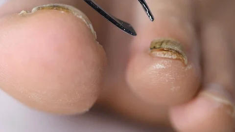 Close-up of doctor's hand examining a deformed nail that comes off a mans foo Stock Footage 118569109