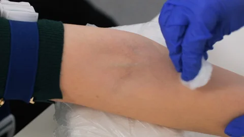 Close-up of the doctor's hands disinfect the injection site with a cotton swab Stock Footage 128372478