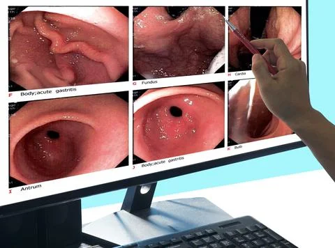 Close up Doctors point out the computer screen, report of gastrointestinal en Stock Photos
