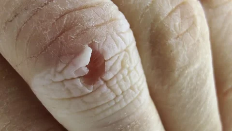 Close-up of dry human finger with severe peeling skin on knuckle revealing Stock Footage 339865570