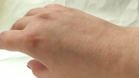A close-up of the dry skin of a young womans hands. Dermatological diseases. Stock Footage 323686271