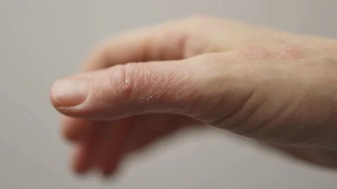 Close-up eczema dermatitis dry skin cracks on hand, thumb allergies condition Stock Footage
