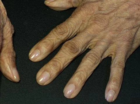 Close-Up of an Elderly Womans Hand Showing the Signs of Aging Stock Photos