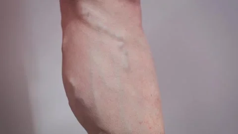 Close-up of an elderly woman's leg with varicose veins Stock-Footage 330496818
