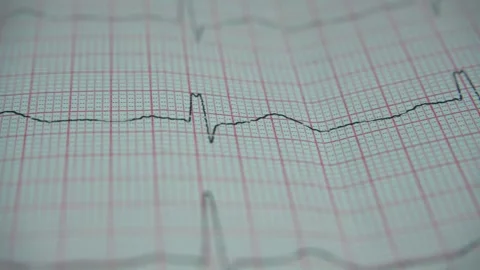 Close up of electrocardiogram in paper form Stock-Footage 263590266