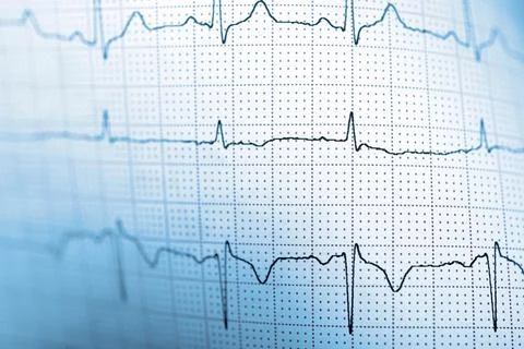 Close-up of an electrocardiogram printed on blue paper. 스톡 사진
