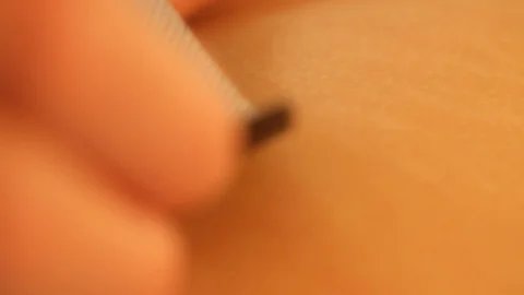 A close-up of the electrodes for electro myo stimulation therapy.Hardware Video stock 115569660