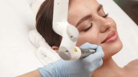 Close-up of erbium laser working on pretty woman face Stock-Footage 143162079