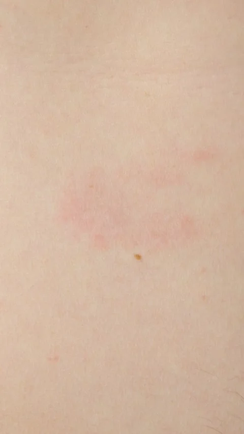Close-up of erythema migrans rash caused by Lyme disease on patient skin. Video stock 339615079