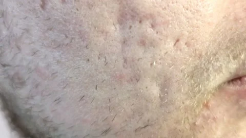 Close-up examination of skin condition showcasing texture and imperfections on t Stock Footage 292753746