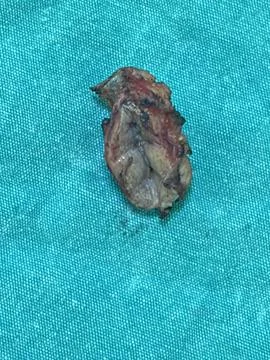 Close-Up of Excised Pilonidal Sinus Tissue on a Surgical Drape Stock Photos
