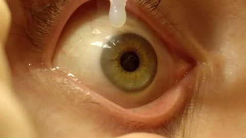 Close up of eye drop application on contact lens Stock Footage 321725836