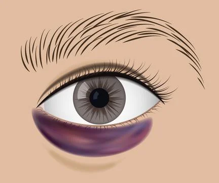 Close-Up of Eye with purple Under-Eye Bruise Stock Illustration