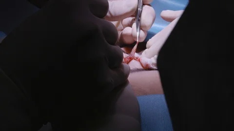 Close-up of eye surgery. Plastic surgery. Clinic. Scalpel cut flesh Stock Footage 124403580