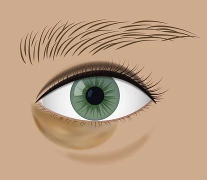 Close-Up of Eye with yellow Under-Eye Bruise Stock Illustration