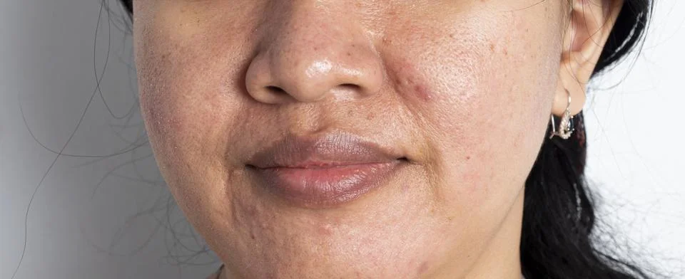 Close-up of a face covered in pockmarks and acne. An Asian woman's face is .. Stock Photos