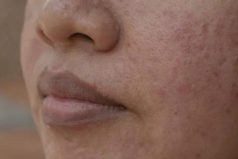 Close-up of a face covered in pockmarks and acne. An Asian woman's face is .. 库存照片