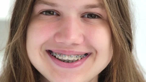 Close up face of happy smiling joyful caucasian girl with dental braces Stockbeeldmateriaal 340488843