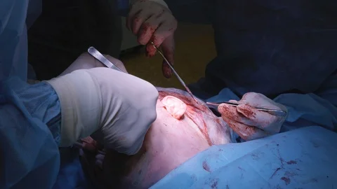 Close-up face surgery. Plastic surgery. Face lift Stock Footage 124403531