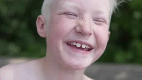 A close-up of the face of a young boy who burned in the sun is blond Stock Footage 132922081