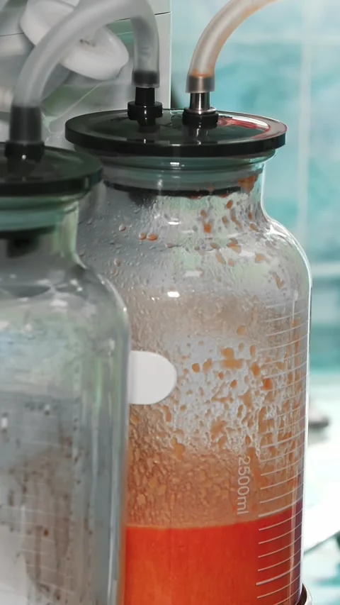 Close-up. fat pumped out from patient during abdominal liposuction procedure is Stock-Footage 323083704