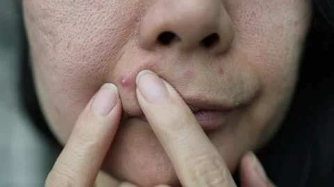 Close up of female face with red problematic acne skin, blurry background Stock Footage 334628367