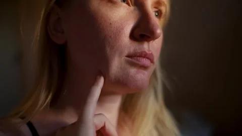 Close up of female face skin with post acne scars, enlarged pores, and rosacea. Stock-Footage 345050656