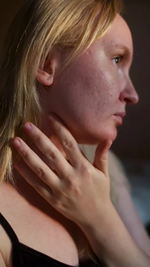 Close up of female face skin with post acne scars, enlarged pores, and rosacea. Stock Footage 345050667