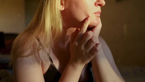 Close up of female face skin with post acne scars, enlarged pores, and rosacea. Video stock 345050674