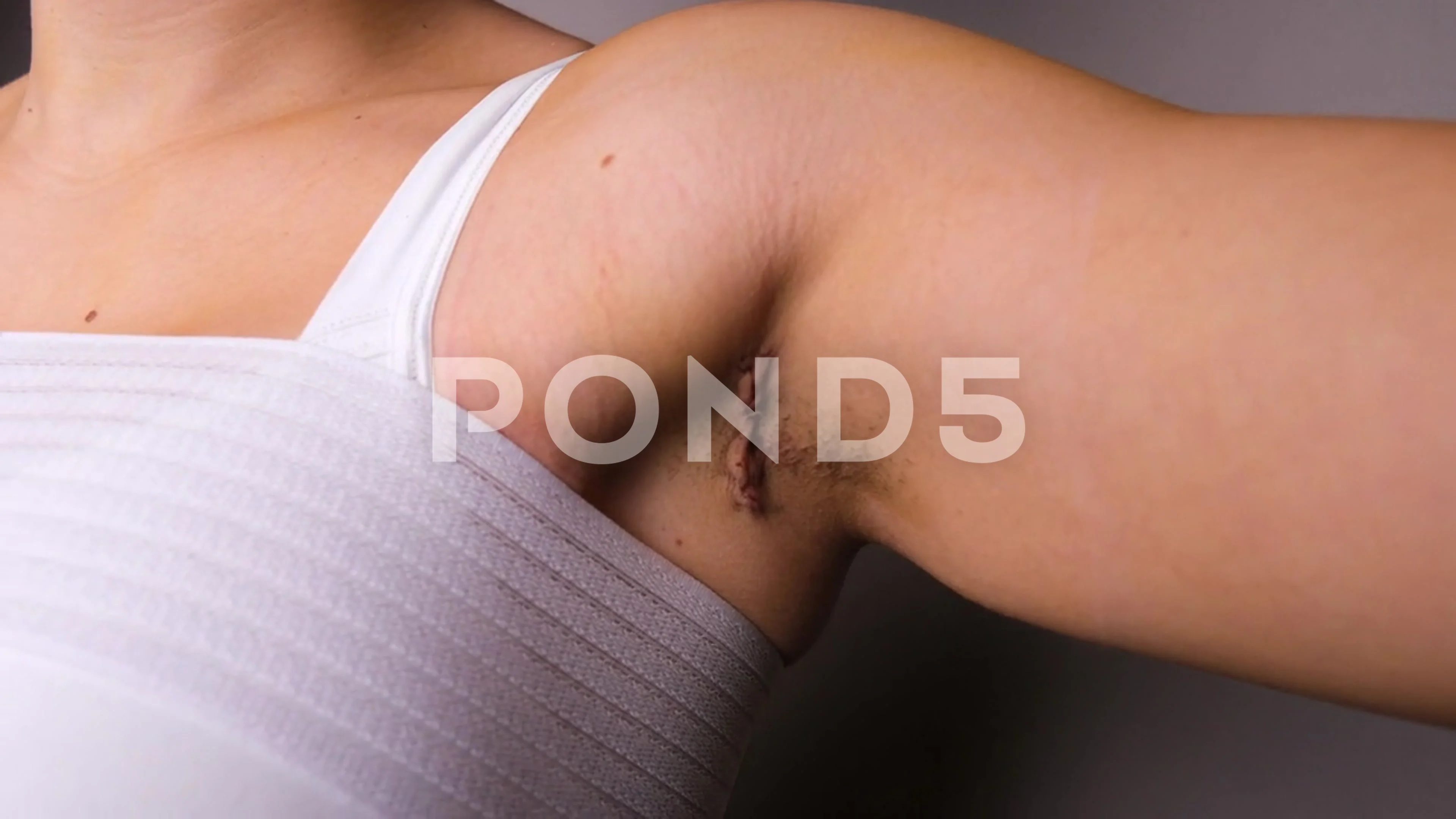 Close Up Of Females Armpit Scar Post Tra, Stock Video