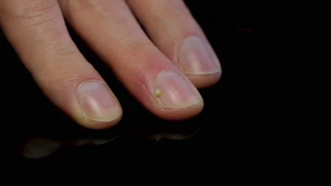 North Carolina woman says she was left with fungal infection and bloody  fingers after manicure | Daily Mail Online