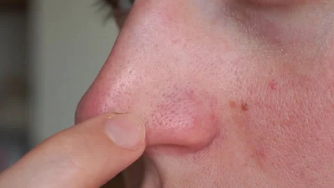 Close-Up of Finger Pressing Mole on Face – Dermatology Skin Check Concept Video stock 313442485