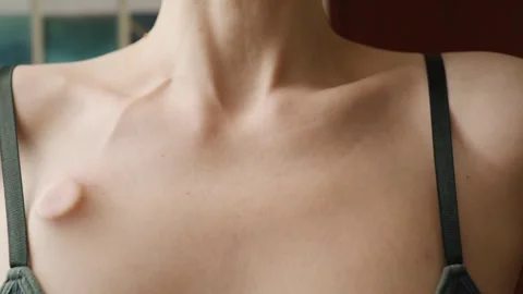 Close-up of fingers gently touching an implanted chest port near a clothing.. Stock Footage 339332225