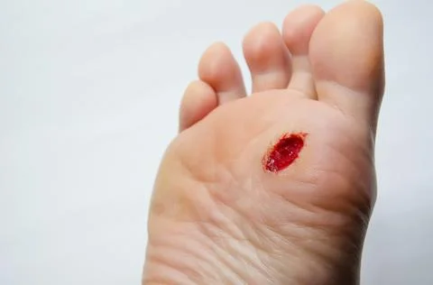 Close up foot after surgery to remove verruca. Injury feet. Bleeding wound. Stock Photos