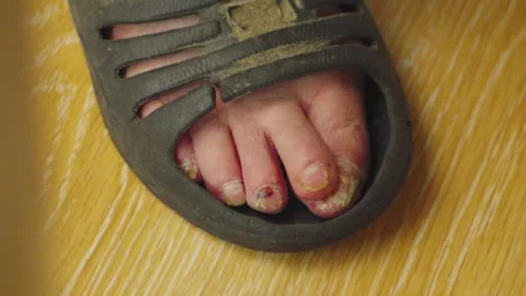 Close-up of a foot with visible toe disease while wearing a sandal on wooden Video stock 284873005