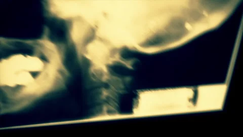 Close up of a front and side skull x-rays moving erratically on the screen. Stock Footage 145363224
