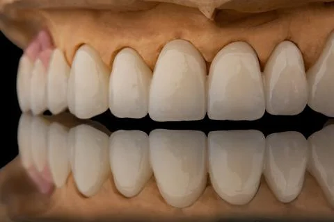 Close-up front view of a dental upper jaw prosthesis on black glass background Stock Photos